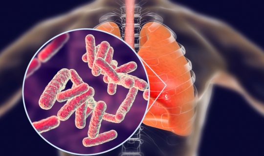 एक Tuberculosis रोगी के लिए 5 आदर्श खाद्य पदार्थ