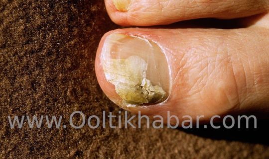 जानें Toenail Fungus के लिए क्यों नहीं इस्तेमाल करनी चाहिए Bleach