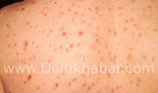 Chickenpox को ठीक करने के घरेलू उपाय