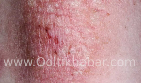 Eczema से बचने के घरेलू उपाए