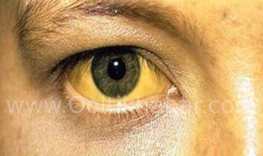 पीलिया (Jaundice)से बचने के घरेलू उपाय