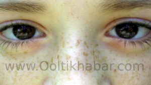 Freckles (झाइयां) कि समस्या को दूर करने के घरेलू उपाय