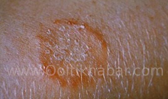 Ringworm  (दाद) की समस्या को दूर करने के घरेलू उपाय