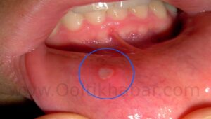 Ulcer (पेट में छाले या घाव) को ठीक करने के घरेलू उपाय