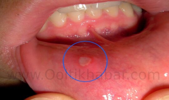 Ulcer (पेट में छाले या घाव) को ठीक करने के घरेलू उपाय