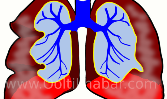 Bronchitis (स्वास नली में सूजन) की  समस्या को दूर करने के घरेलू उपाय