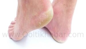 Calluses (Cracked Heels) से छुटकारा पाने के असरदार घरेलू नुस्खे