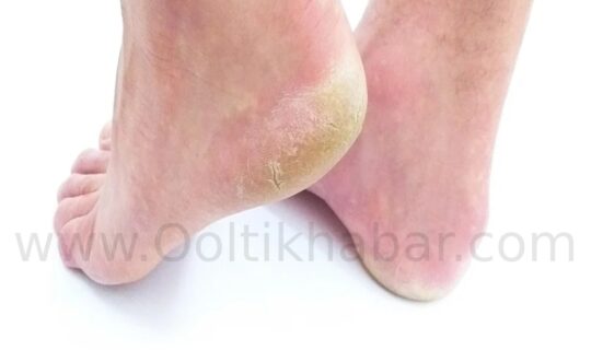 Calluses (Cracked Heels) से छुटकारा पाने के असरदार घरेलू नुस्खे